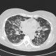Atypical pneumonia: CT - Computed tomography