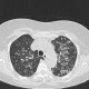 Atypical pneumonia, crazy-paving pattern: CT - Computed tomography