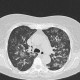 Atypical pneumonia, crazy-paving pattern: CT - Computed tomography