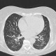 Atypical pneumonia, crazy-paving pattern: CT - Computed tomography