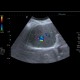Arteriovenous malformation of liver, AV malformation: US - Ultrasound