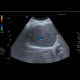 Arteriovenous malformation of liver, AV malformation: US - Ultrasound