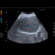 Arteriovenous malformation of liver, AV malformation: US - Ultrasound