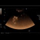Arteriovenous malformation of liver, AV malformation, CEUS: US - Ultrasound