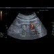 Arteriovenous malformation of kidney: US - Ultrasound