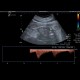 Arteriovenous malformation of kidney: US - Ultrasound