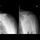 Abruption of the rim of glenoid: X-ray - Plain radiograph
