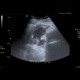 Abscess, Crohn's disease, intra-abdominal abscess: US - Ultrasound