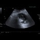 Abscess, Crohn's disease, intra-abdominal abscess: US - Ultrasound