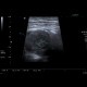 Abscess, Crohn's disease, intra-abdominal abscess: US - Ultrasound