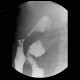 Abscess, cutaneous fistula, colonic fistula: RF - Fluoroscopy