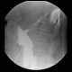 Abscess, cutaneous fistula, colonic fistula: RF - Fluoroscopy