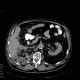 Abscess, cutaneous fistula, colonic fistula: CT - Computed tomography