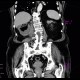 Abscess, cutaneous fistula, colonic fistula: CT - Computed tomography