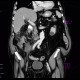 Abscess, cutaneous fistula, colonic fistula: CT - Computed tomography