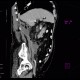 Abscess, cutaneous fistula, colonic fistula: CT - Computed tomography
