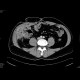 Abscesses in abdominal wall following appendectomy: CT - Computed tomography