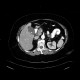 Acute cholecystitis, CT: CT - Computed tomography