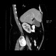 Acute cholecystitis, CT: CT - Computed tomography