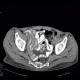 Acute enterocolitis, enteritis and colitis: CT - Computed tomography