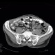 Acute enterocolitis, enteritis and colitis: CT - Computed tomography
