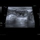 Acute enterocolitis, enteritis and colitis: US - Ultrasound