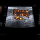 Acute enterocolitis, enteritis and colitis: US - Ultrasound
