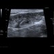 Acute enterocolitis, enteritis and colitis: US - Ultrasound