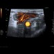 Acute enterocolitis, enteritis and colitis: US - Ultrasound