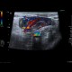 Acute enterocolitis, enteritis and colitis: US - Ultrasound
