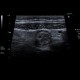 Acute colitis, inflammatory lymph nodes: US - Ultrasound