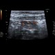 Acute colitis, inflammatory lymph nodes: US - Ultrasound