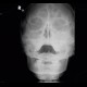 pansinusitis, sinusitis, acute, Water's view: X-ray - Plain radiograph