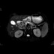 Adenocarcinoma of biliary duct: MRI - Magnetic Resonance Imaging