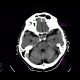 Adenoma of hypophysis: CT - Computed tomography