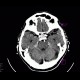 Adenoma of hypophysis: CT - Computed tomography