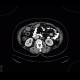 Sigmoid adenocarcinoma, peritoneal metastasis: CT - Computed tomography