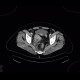 Sigmoid adenocarcinoma, peritoneal metastasis: CT - Computed tomography