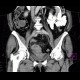 Sigmoid adenocarcinoma, peritoneal metastasis: CT - Computed tomography