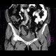 Sigmoid adenocarcinoma, peritoneal metastasis: CT - Computed tomography