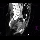 Sigmoid adenocarcinoma, peritoneal metastasis: CT - Computed tomography