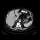 Adrenal adenoma: CT - Computed tomography
