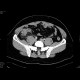 Acute appendicitis: CT - Computed tomography