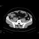 Acute appendicitis: CT - Computed tomography