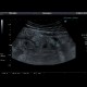 Acute appendicitis: US - Ultrasound