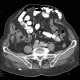 Acute appendicitis: CT - Computed tomography