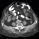 Acute appendicitis: CT - Computed tomography