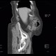 Acute appendicitis: CT - Computed tomography