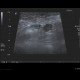 Acute appendicitis: US - Ultrasound