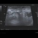 Acute appendicitis: US - Ultrasound